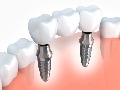 Braces & Implant Treatment in Ludhiana