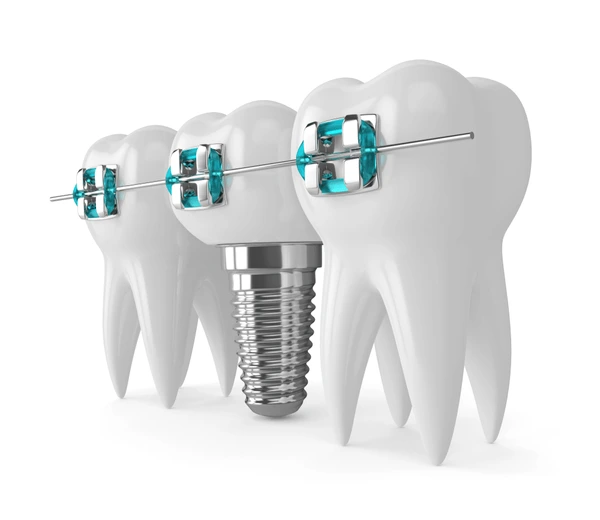 Teeth Whitening Treatment in Ludhiana
